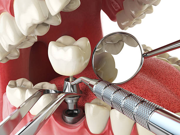 Best Emergency Wisdom Tooth Extraction in Heber Springs, AR